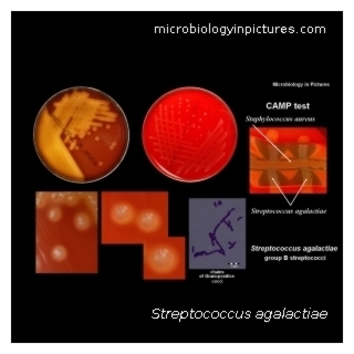 Group B steptococcus